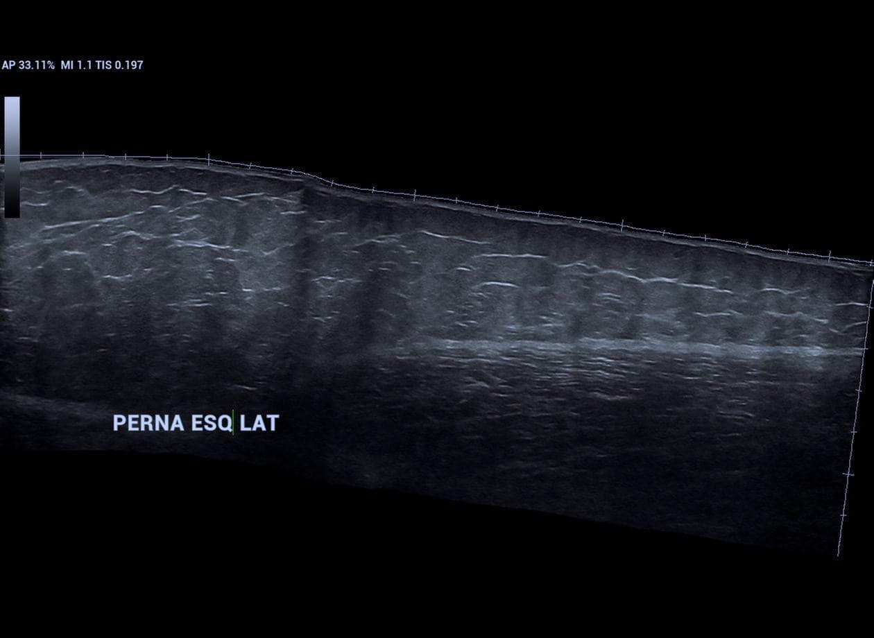 Exame de tecido subcutâneo / lipedema